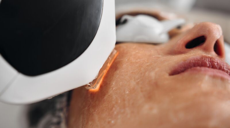 Rosacea laser_eraesthetic.de